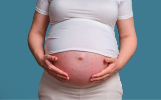 Unreine Haut in der Schwangerschaft